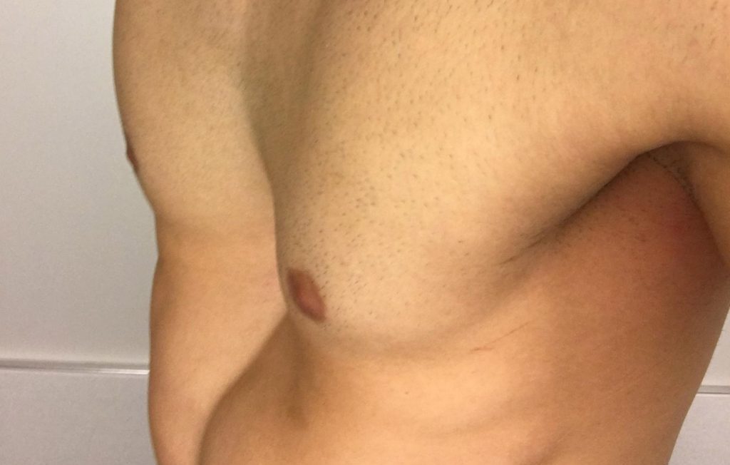 Pectus Excavatum o pecho hundido: ¿Cómo la cirugía plástica puede ayudar a corregirlo?